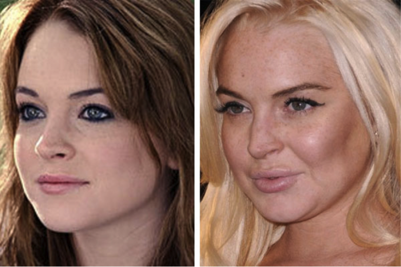 gorgeous-stars-before-and-after-botox-08