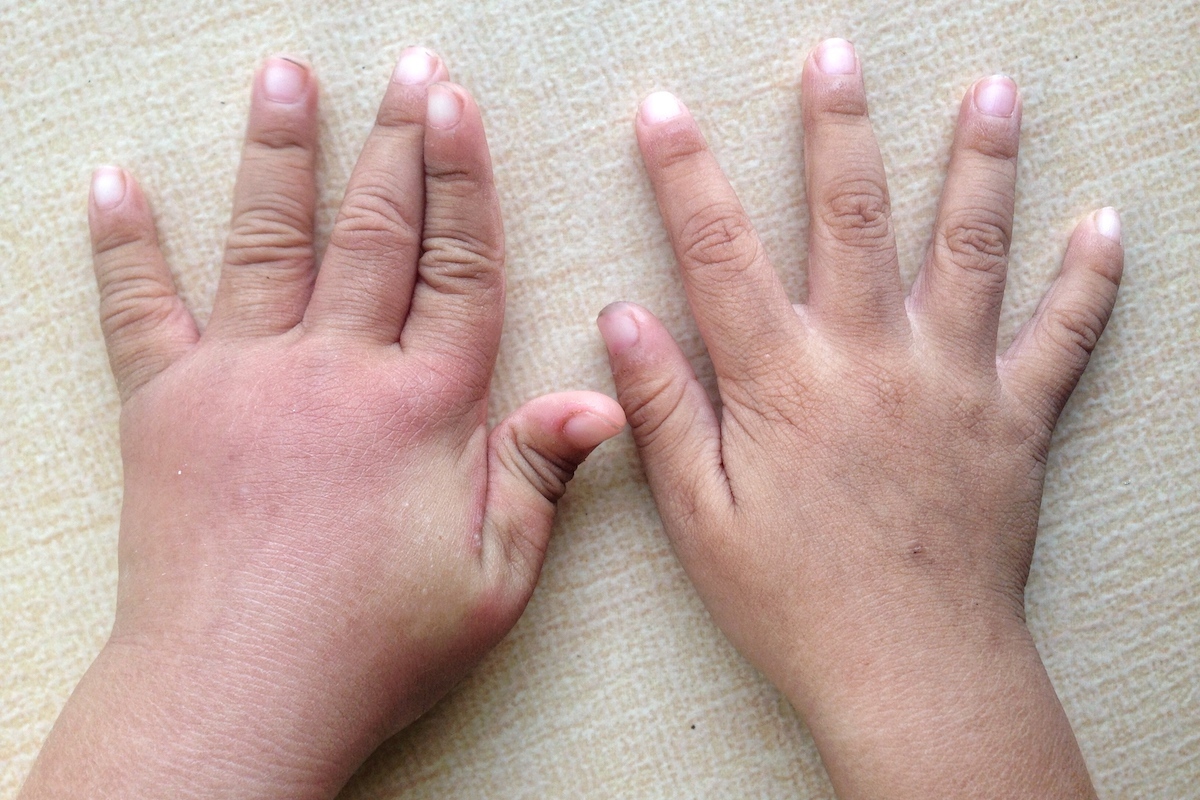 swollen children's hands