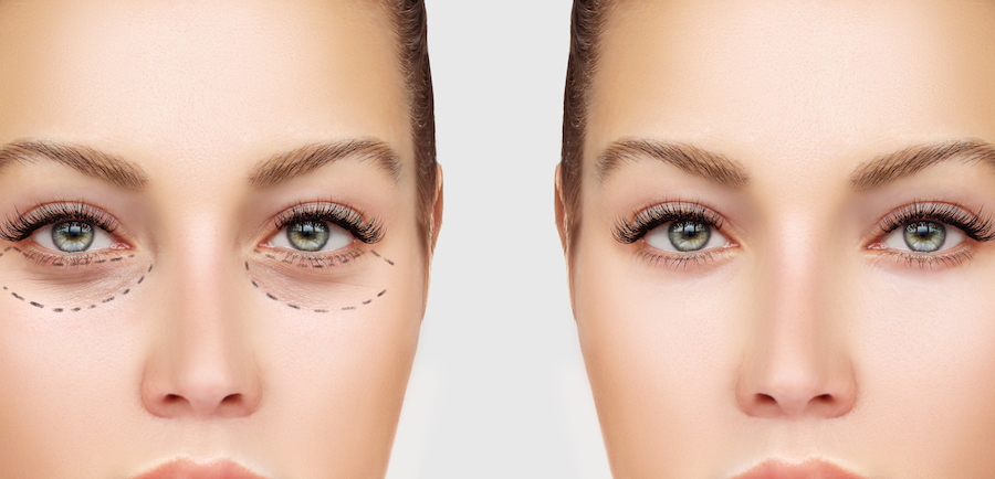 Upper Eyelid Surgery | Blepharoplasty – Eyelid Surgery For A Fresher, Younger Look | Her Beauty