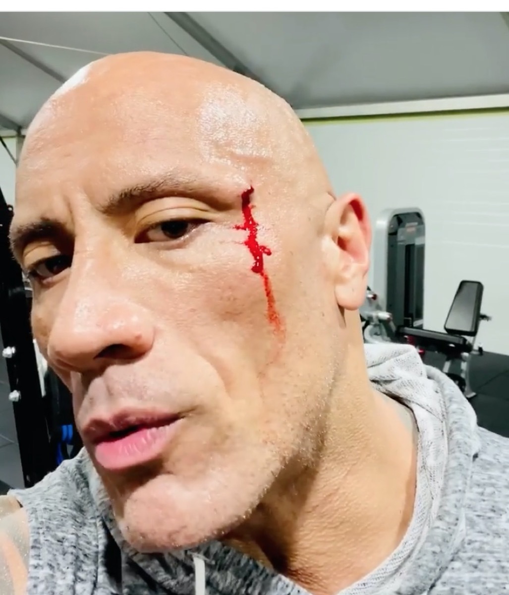 the rock injury