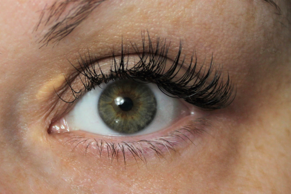 closeup on face of woman with high cholesterol has xanthelasma on eye