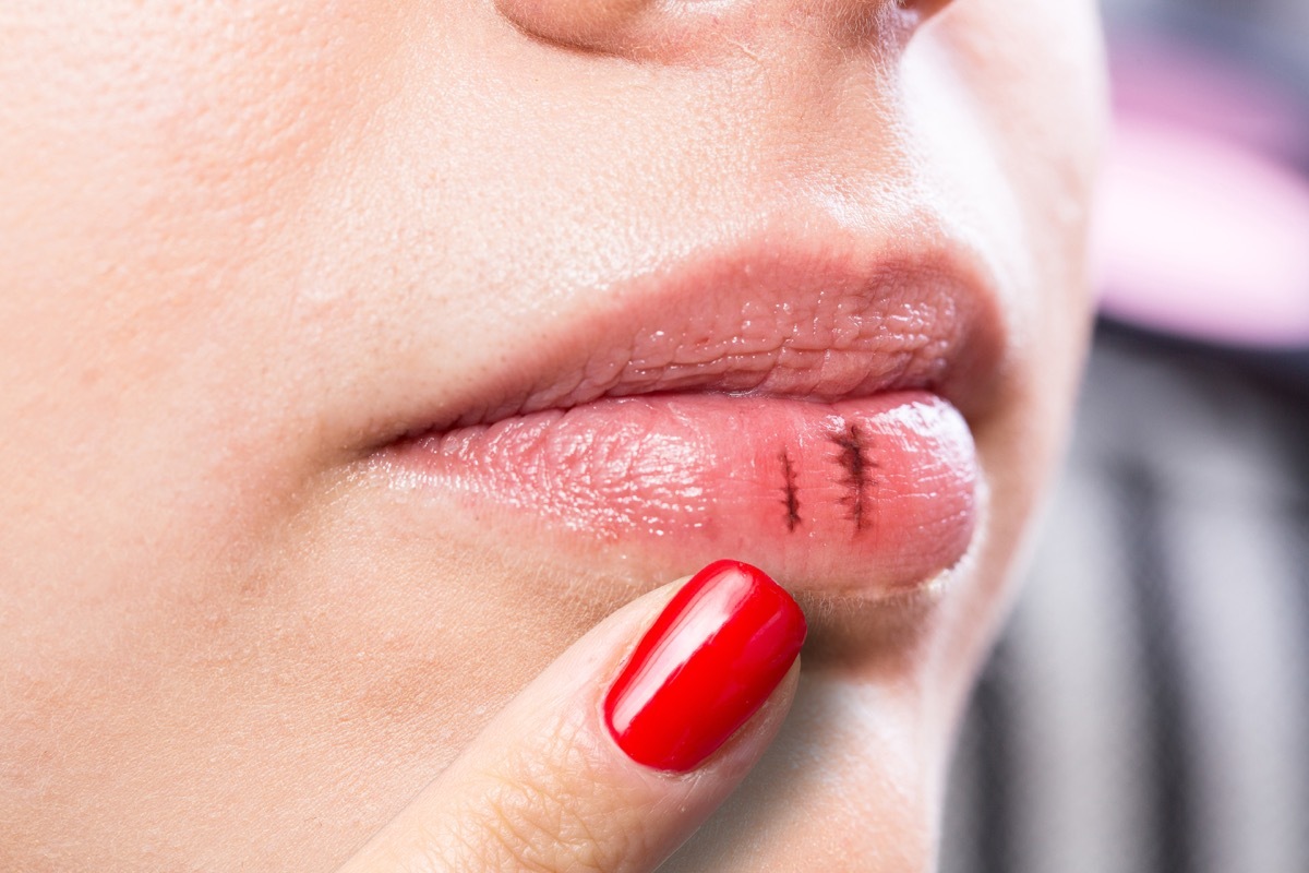 Woman with Chapped and Bleeding Lips Surprising Symptoms