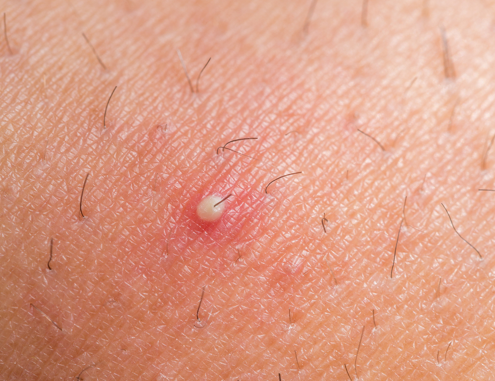 A closeup of an ingrown hair